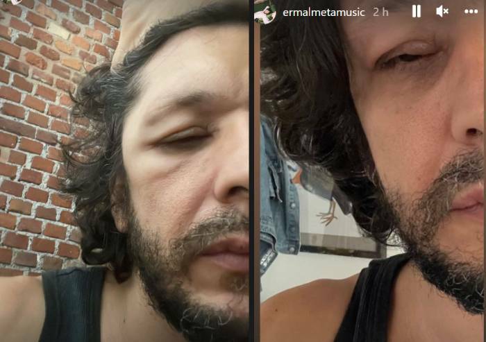 Ermal Meta prova a rassicurare i fan preoccupati per la sua strana malattia