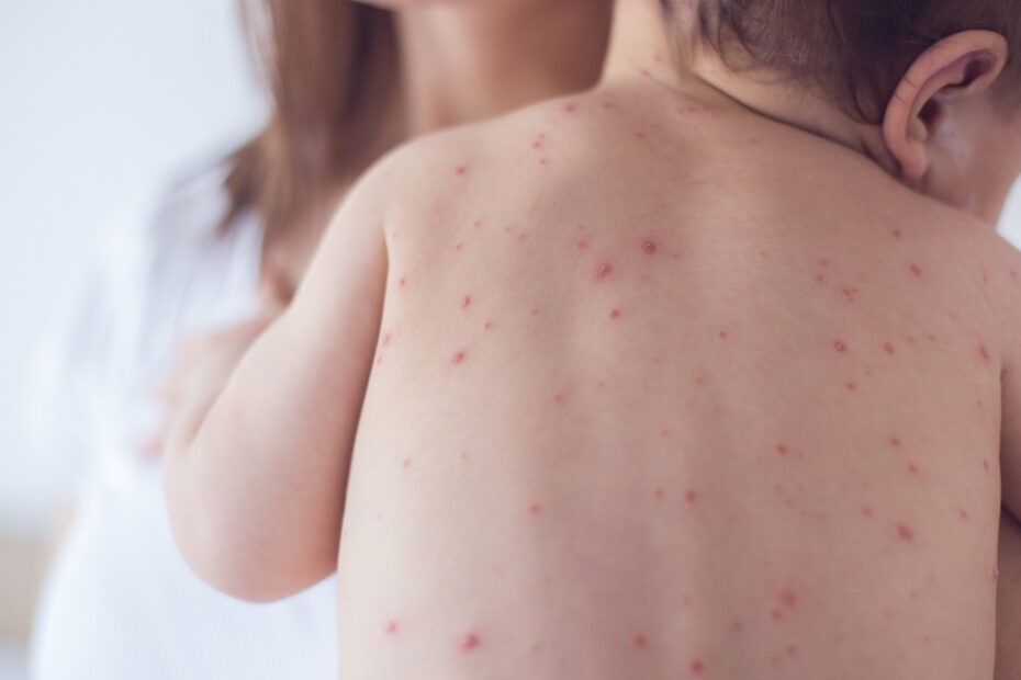 enterovirus neonati allarme Oms