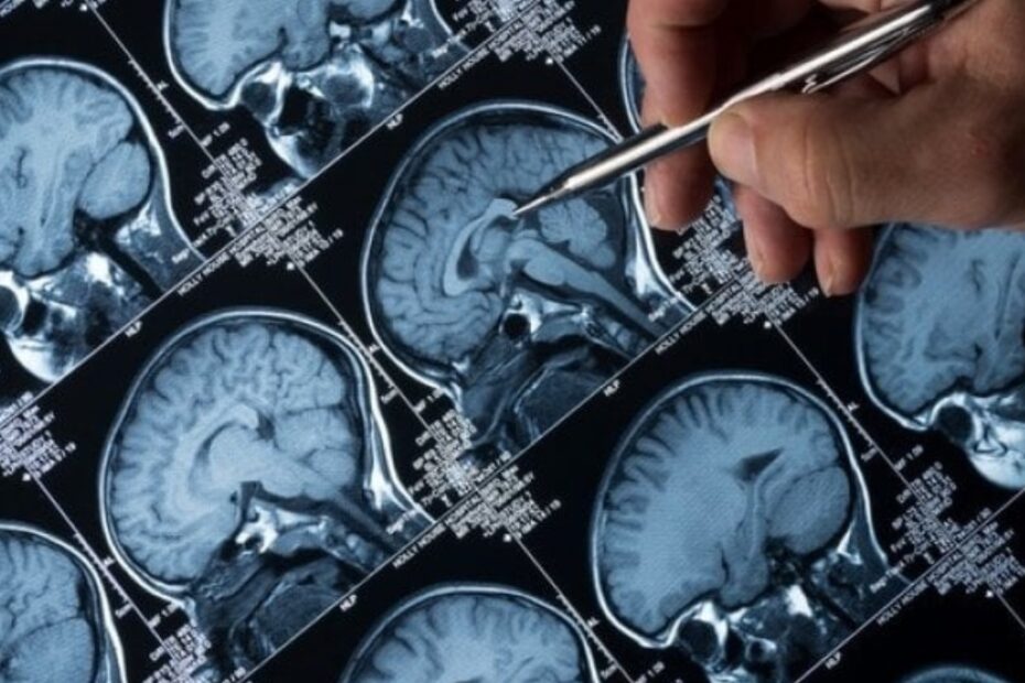 alzheimer camminare rallenta declino